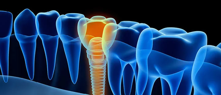 Dental implantın diş kökü yerine yerleştirilmesini gösteren çizim.