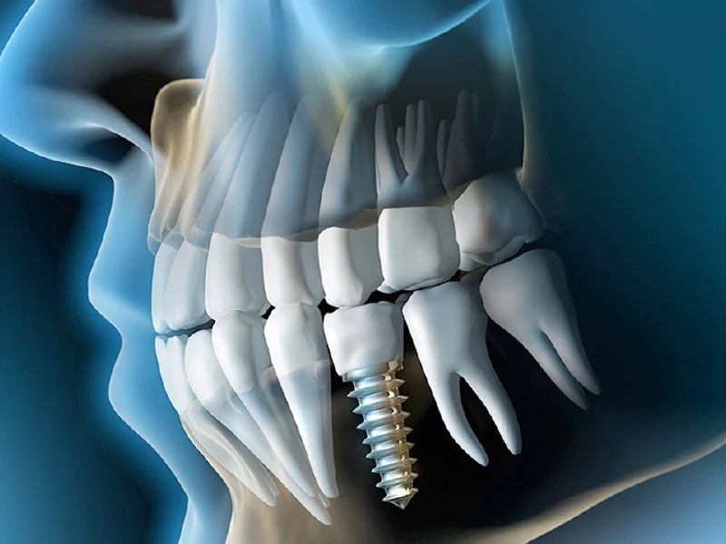 Çene kemiği içinde implantın konumunu gösteren çizim.